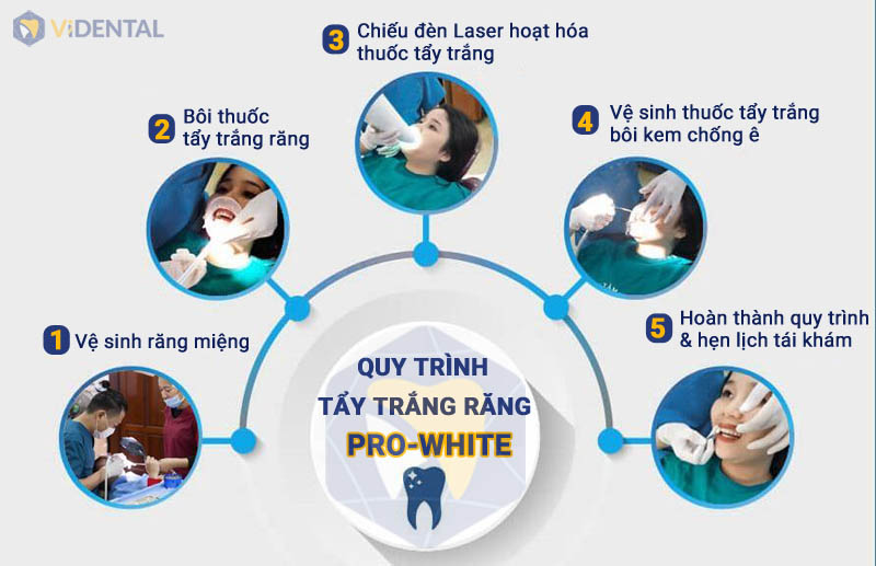Quy trình tẩy trắng răng được thông báo trước để khách hàng theo dõi trình tự chi tiết