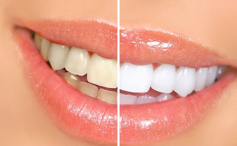 Phương pháp tẩy trắng răng mang lại hiệu quả tương đối cao