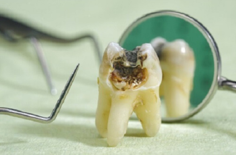 Răng có lỗ sâu lớn, sát với buồn tủy thì nên chữa trị càng sớm càng tốt