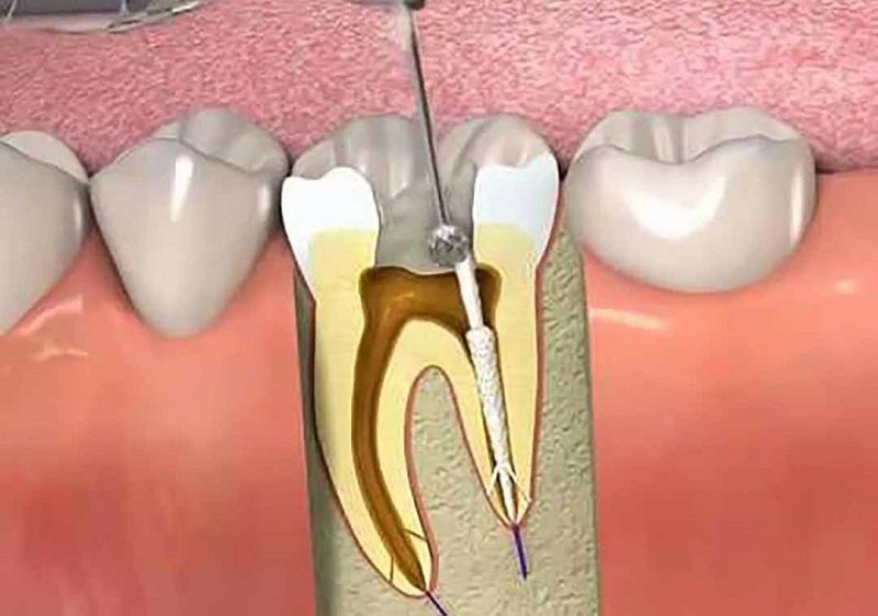 Điều trị tủy răng sẽ không đau nếu được thực hiện bởi bác sĩ giỏi
