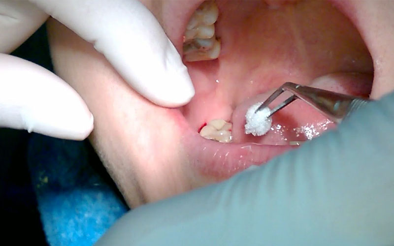 Lưu ý cho bệnh nhân trước và sau khi nhổ răng khôn
