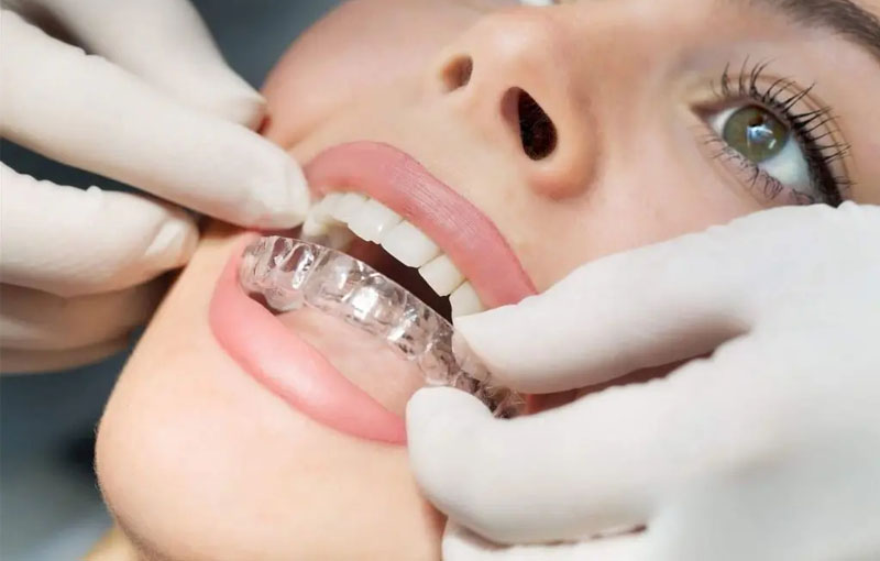 Quy trình niềng răng tháo lắp chuẩn gồm 7 bước