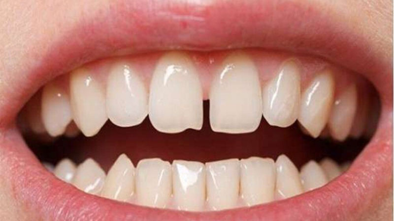 Tình trạng răng thưa gây ảnh hưởng đến thẩm mỹ