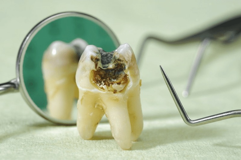 Chi phí nhổ răng khôn hàm trên phụ thuộc vào nhiều yếu tố