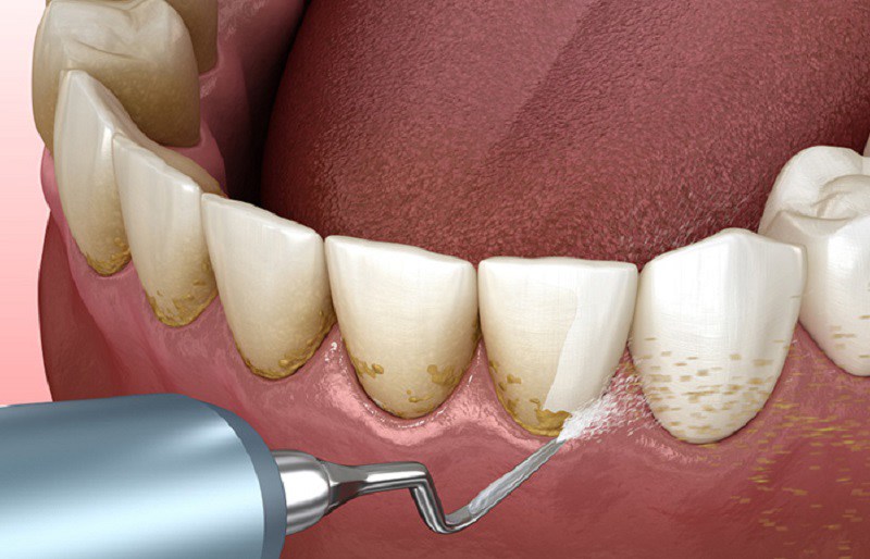 Thực hiện lấy cao răng để tránh bị đau nướu răng