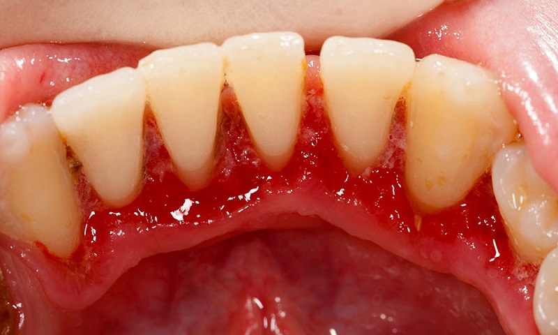 Viêm nướu răng là tình trạng bệnh lý răng miệng phổ biến