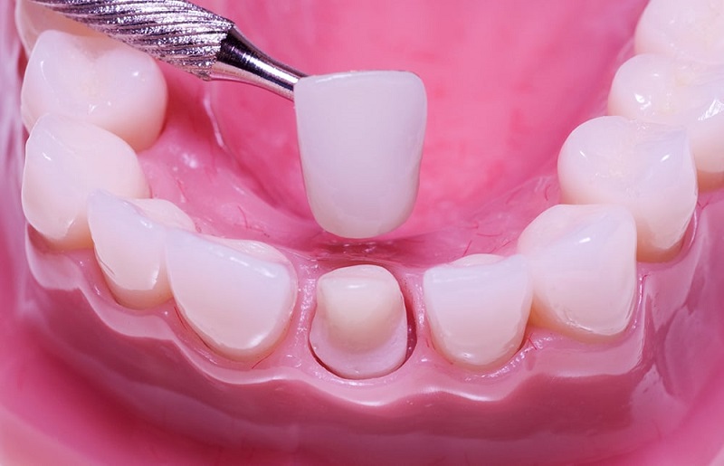 Bọc răng sứ thẩm mỹ là một giải pháp phục hình răng phổ biến