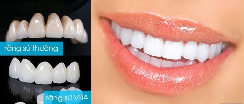 Crystal Vita được mệnh danh là răng sứ kim cương