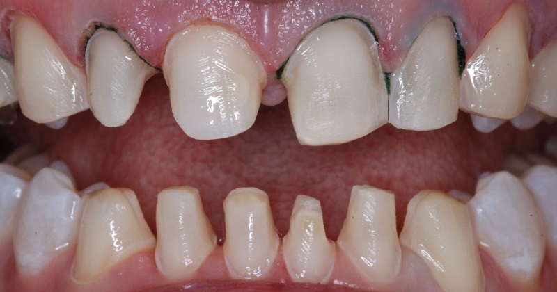 Nếu kỹ thuật mài cùi răng không tốt, chúng sẽ khiến răng bạn hư tổn vĩnh viễn