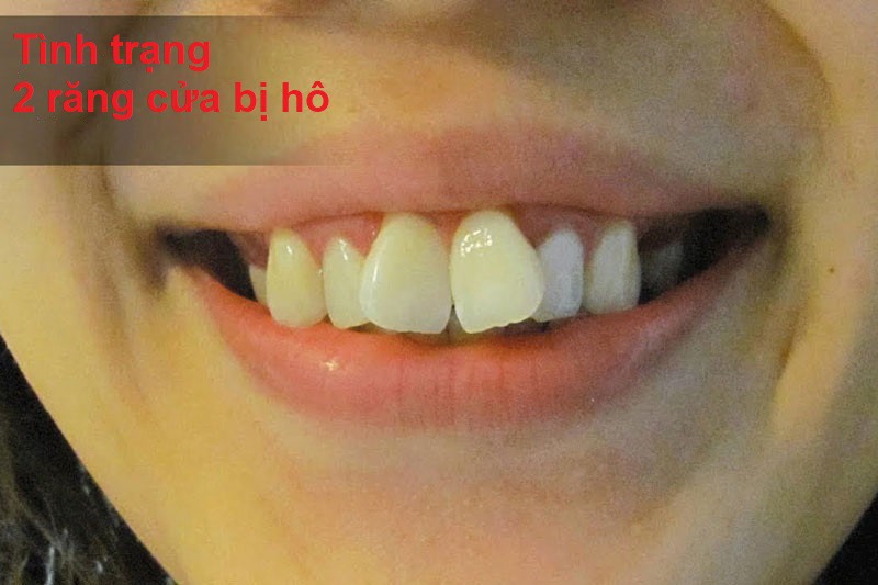 Tình trạng 2 răng cửa hàm trên bị hô