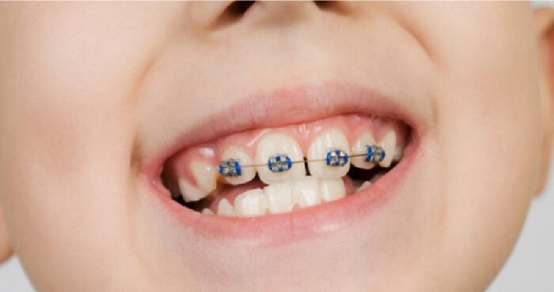 Niềng 2 răng cửa bị hô ở trẻ em sẽ nhanh hơn so với người lớn