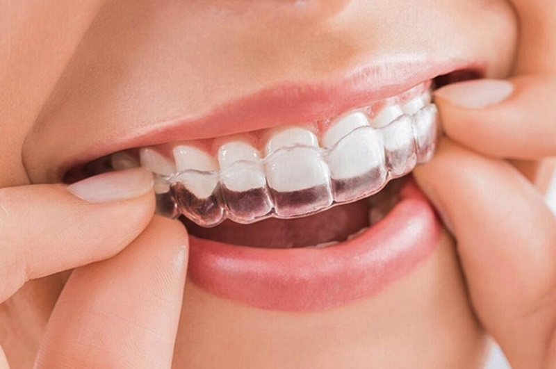 Phương pháp niềng răng Invisalign