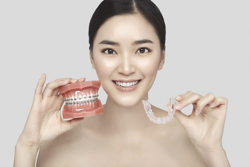 Niềng Răng không mắc cài 3D Clear là phương pháp chỉnh nha phổ biến