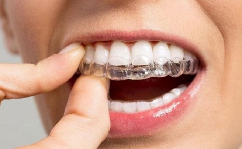 Quy trình thực hiện niềng răng 3D Clear khá đơn giản