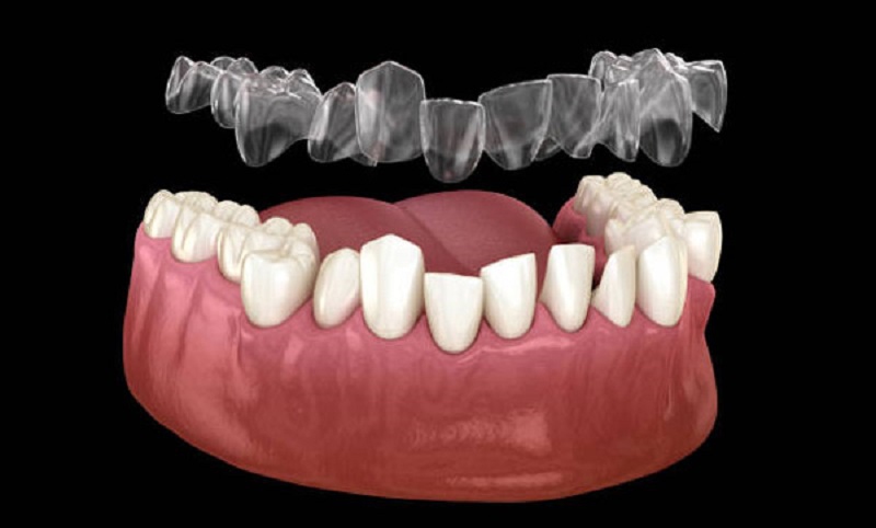 Giá niềng răng 3D Clear phụ thuộc chủ yếu vào tình trạng răng miệng của bệnh nhân