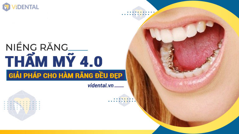 niềng răng tại ViDental Brace không đau, hạn chế nhổ răng, rút ngắn thời gian