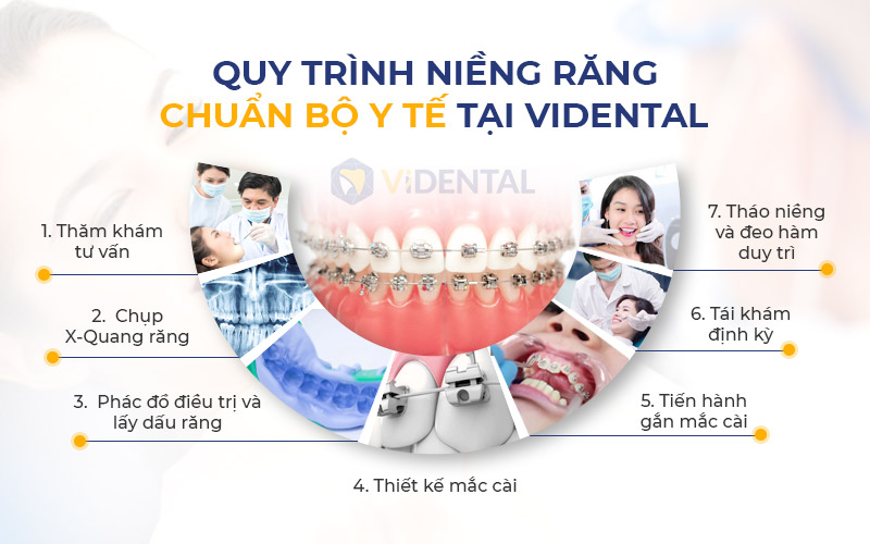 Quy trình niềng răng tại ViDental Brace