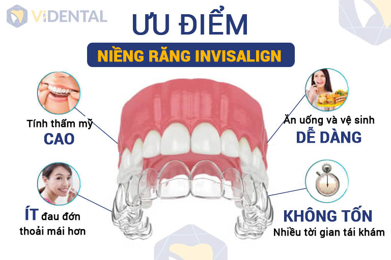 Niềng răng Invisalign là phương pháp chỉnh nha tối ưu nhất hiện nay