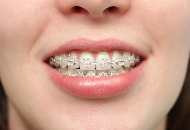 Niềng răng mắc cài pha lê là phương pháp chỉnh nha sử dụng mắc cài bằng pha lê