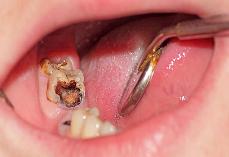 Sâu răng là bệnh lý nha khoa mà rất nhiều người gặp phải