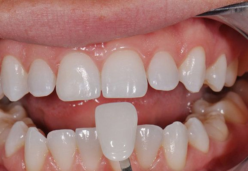 Bọc răng sứ cho răng thưa là giải pháp được nhiều người lựa chọn