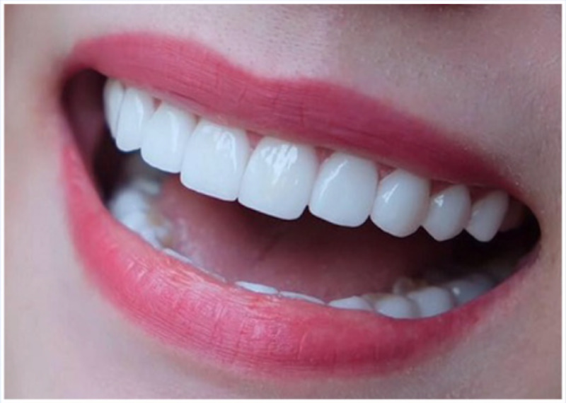 Có rất nhiều yếu tố chi phối tới giá thành dịch vụ bọc răng sứ nên bạn cần lưu ý
