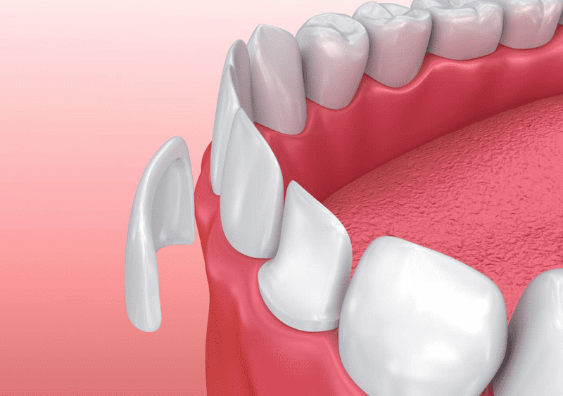 Dán sứ cho răng giúp bảo tồn răng thật một cách tối đa