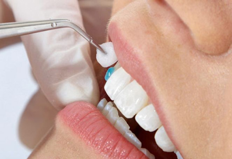 Keo dán răng sứ là một vật liệu không thể thiếu trong quá trình bọc răng sứ, dán sứ thẩm mỹ