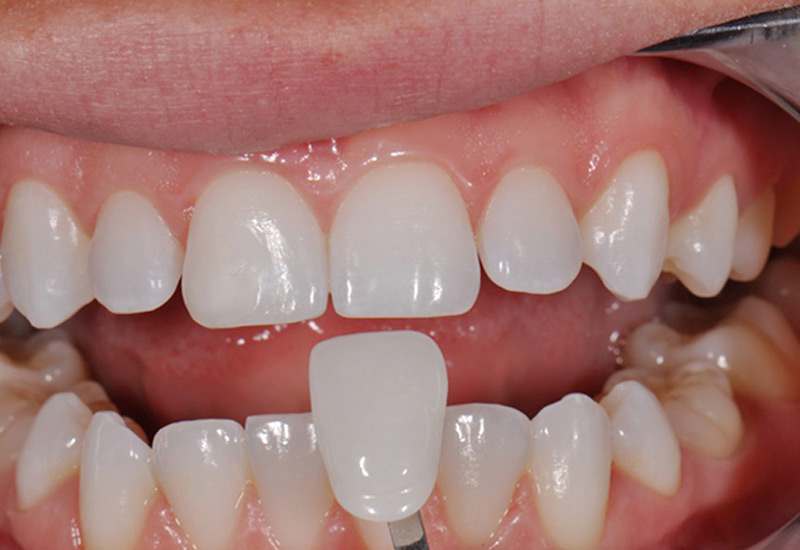 Các trường hợp bọc răng sứ, dán sứ, làm cầu răng sẽ cần keo dán răng chuyên biệt
