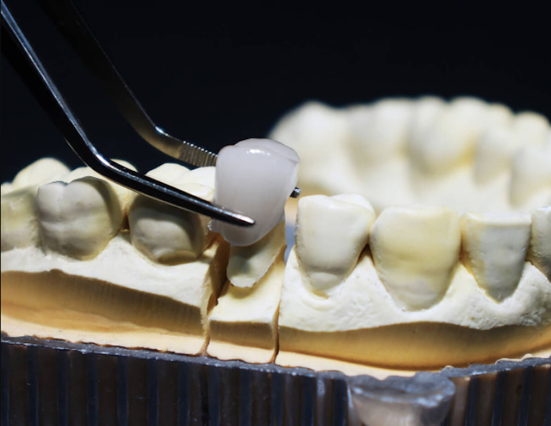 Hiện nay có 2 loại răng sứ chính là răng sứ kim loại và răng sứ toàn sứ
