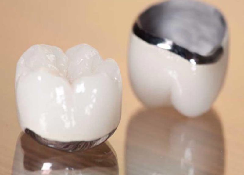 Nên chọn răng sứ kim loại bởi giá thành rẻ và độ bền tương đối