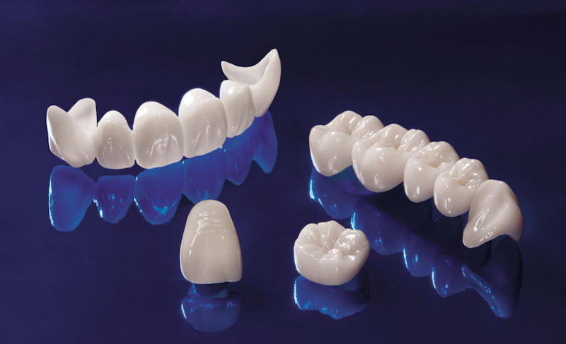 Chọn bọc răng sứ toàn sứ để đem đến độ thẩm mỹ cao và an toàn với cơ thể