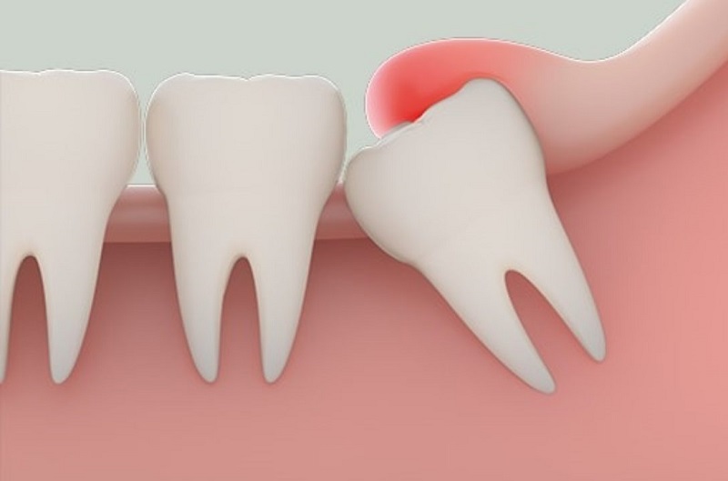 Niềng răng có phải nhổ răng khôn không là vấn đề nhiều người quan tâm