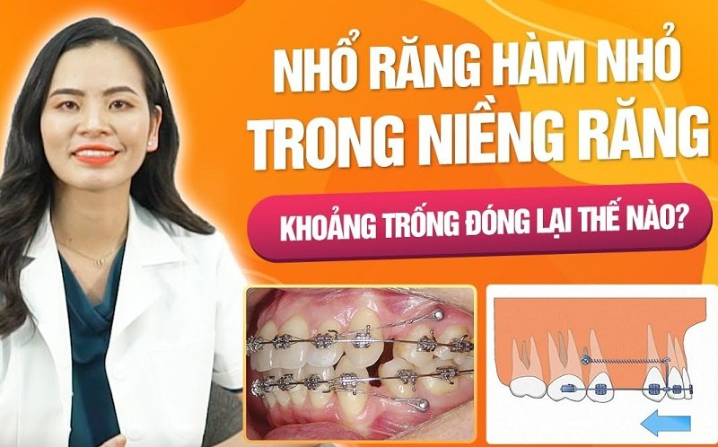 Các bác sĩ nha khoa cho biết, nhổ răng số 5 không nguy hiểm