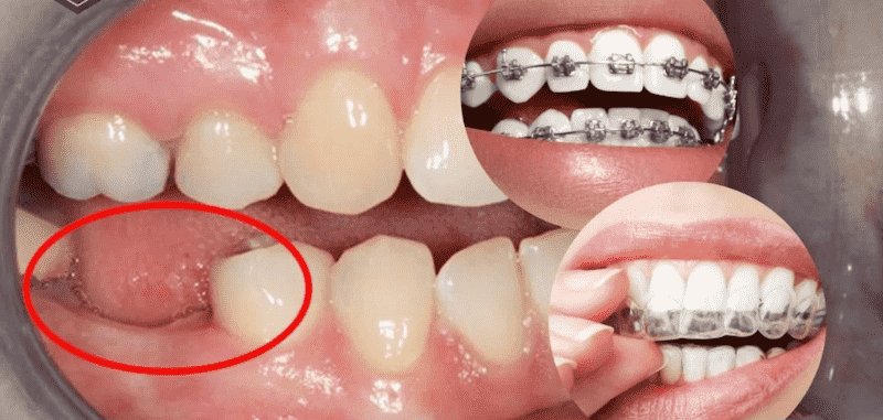 Những trường hợp nên nhổ răng số 6 trước khi niềng 