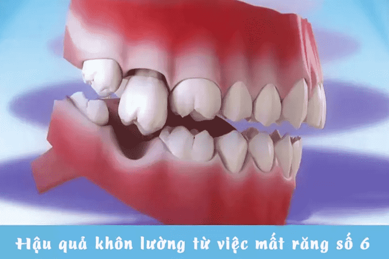 Ảnh hưởng nghiêm trọng của việc mất răng hàm lớn số 6 là làm tiêu xương hàm