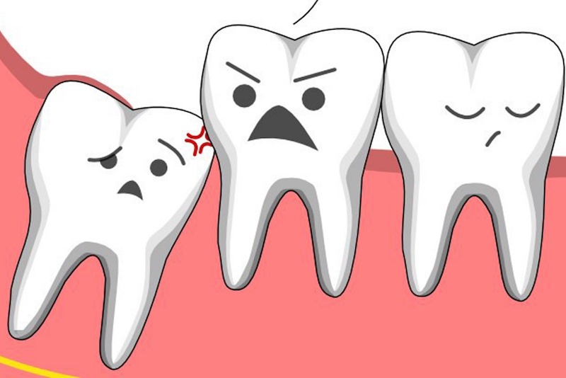 Răng số 8 còn gọi là răng khôn, là chiếc răng mọc cuối cùng trên hàm