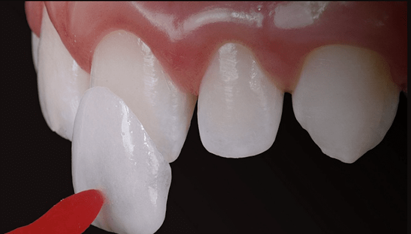 Dùng keo chuyên dụng dán vĩnh viễn mão sứ trên răng