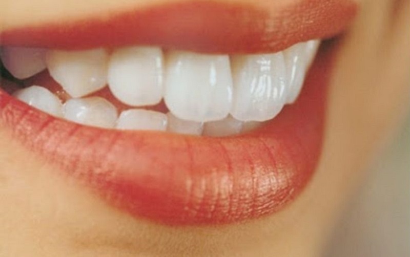 Răng hô nhẹ hay còn được gọi là răng vẩu