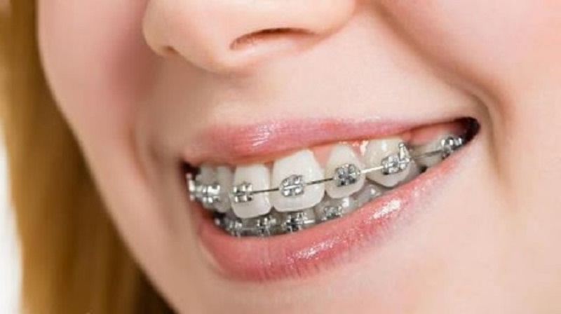 Niềng răng là phương pháp tối ưu khi răng bị hô nhẹ