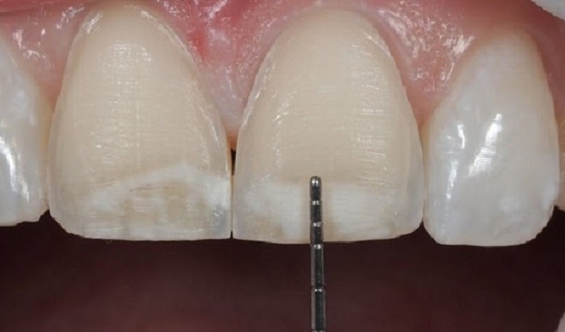 Mài răng hô nhẹ là kỹ thuật ít khi được khuyến khích áp dụng