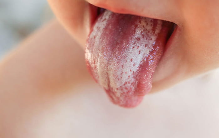 Biểu hiện của bệnh nấm lưỡi phổ biến nhất