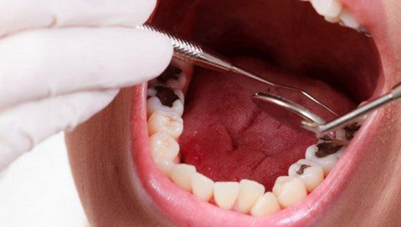 Răng hàm bị sâu quá nghiêm trọng thì nên thực hiện bọc sứ