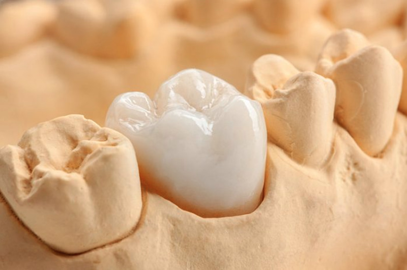 Giá bọc sứ răng hàm phụ thuộc vào chất lượng răng, cơ sở thực hiện,...
