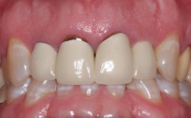 Bọc răng sứ bị hở do nhiều nguyên nhân khác nhau