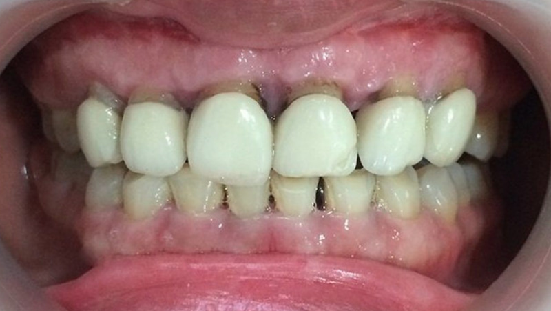 Chân răng bắt đầu bị đen và lan ra là dấu hiệu của bọc răng sứ bị hở