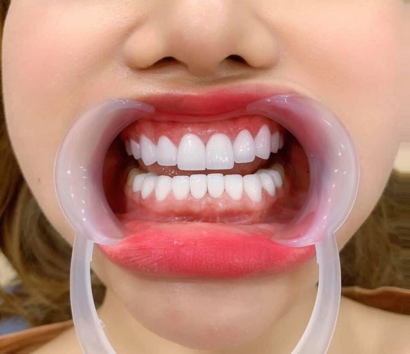 Chi phí bọc răng sứ cho răng hô phụ thuộc vào số lượng răng cần thực hiện