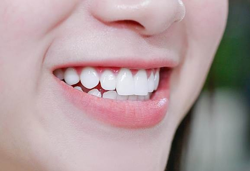 Bọc răng sứ có ăn uống bình thường được không là thắc mắc của nhiều người