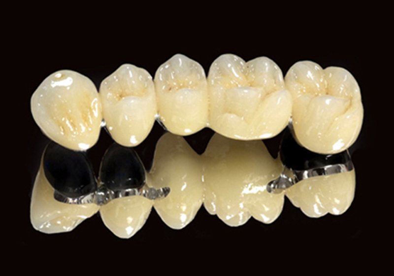 Răng sứ kim loại là loại răng sứ phổ biến được nhiều người lựa chọn