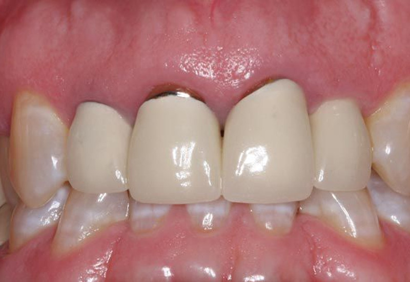 Chất liệu chế tạo nên răng sứ đều được kiểm nghiệm, không gây hại cho sức khỏe